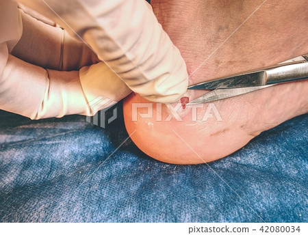 Surgeon cuts patients dead skin, sterile scissors Surgeon cuts patients dead skin, sterile scissors 42080034