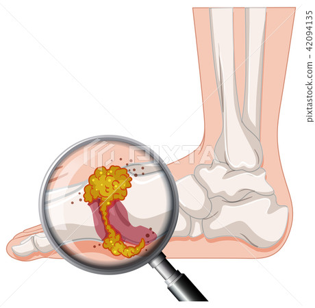 Gout In Human Foot Gout In Human Foot 42094135