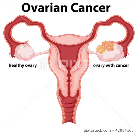 Woman Ovarian Cancer concept drawing Woman Ovarian Cancer concept drawing 42094163