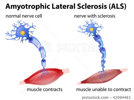 Amyotrophic lateral sclerosis concept Amyotrophic lateral sclerosis concept 42094461