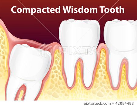Compacted Wisdom Diagram Tooth 42094498