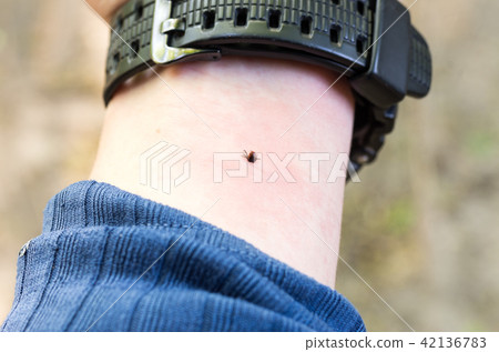 The tick bites his hand. Mite under the skin. 42136783