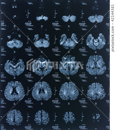 x-ray 42144381
