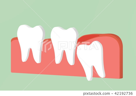 wisdom tooth ( angular or mesial impaction ) wisdom tooth ( angular or mesial impaction ) 42192736