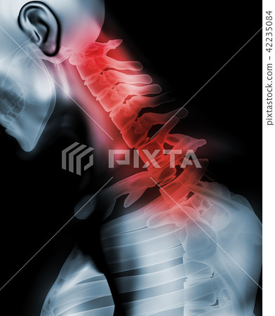 Neck painful - cervical spine, 3D illustration. 42235084