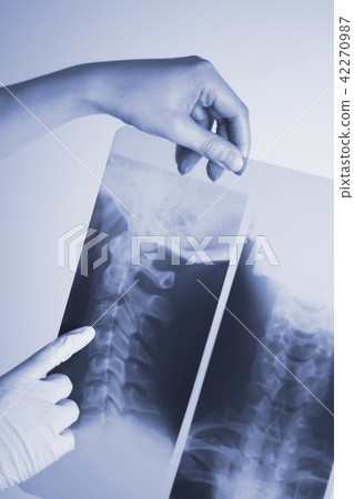 Medical xray spine neck scan 42270987
