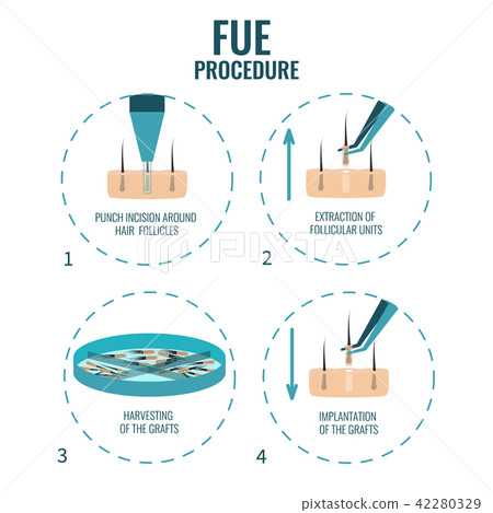 FUE treatment stages 42280329