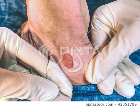 Detail of devastated skin cleaning by medic hands Detail of devastated skin cleaning by medic hands 42351799