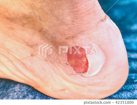 Removing of burned skin from attached tendon. 42351800