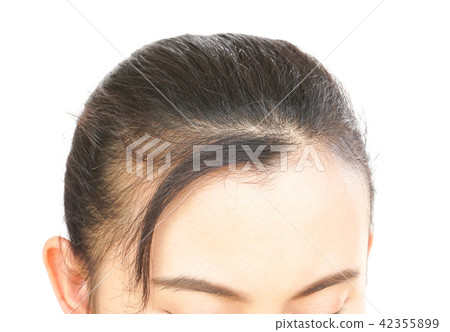 Woman serious hair loss problem for health care Woman serious hair loss problem for health care 42355899
