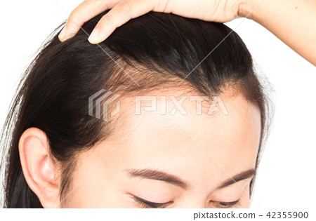 Woman serious hair loss problem for health care Woman serious hair loss problem for health care 42355900