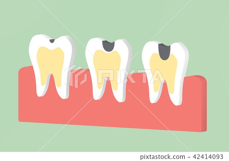 step of decay tooth step of decay tooth 42414093