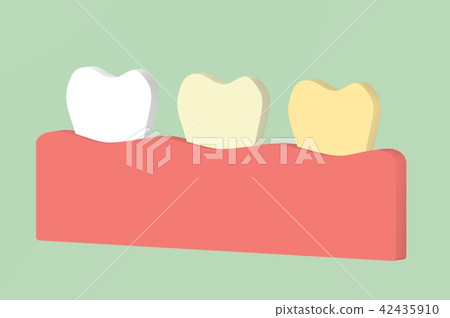 white to yellow tooth, teeth whitening concept white to yellow tooth, teeth whitening concept 42435910