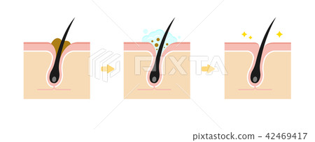 清潔毛孔填充毛孔部分插圖/角塞/皮脂污垢 清潔毛孔填充毛孔部分插圖/角塞/皮脂污垢 42469417