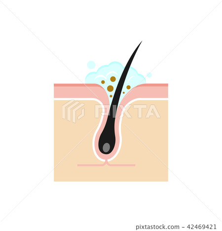 清潔毛孔橫截面圖/角塞/皮脂污垢與清潔 42469421