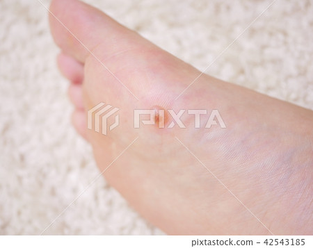 Wart treatment (water blisters) 6 Brighter Wart treatment (water blisters) 6 Brighter 42543185