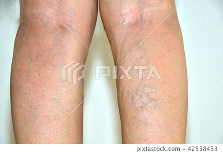 Varicose veins, varicose veins of the lower limbs of women 42558433