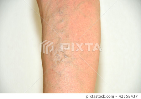 Varicose veins, varicose veins of the lower limbs of women 42558437