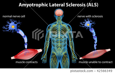 Anatomy of amyotrophic lateral sclerosis - Stock Illustration [42566349 ...