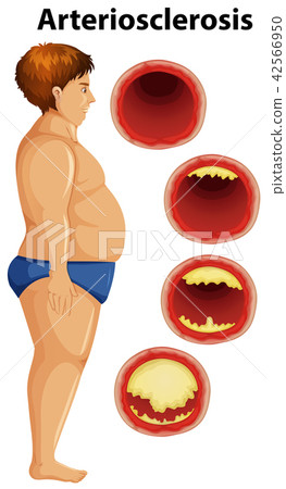 Fat man and arteriosclerosis 42566950