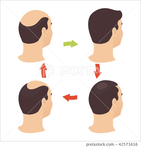 Male hair loss stages set 42571616