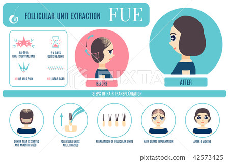 FUE treatment infographic for women FUE treatment infographic for women 42573425