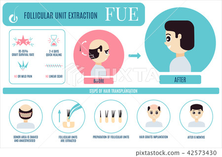 FUE treatment infographic for men 42573430