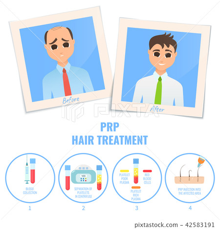 Man before and after PRP treatment Man before and after PRP treatment 42583191