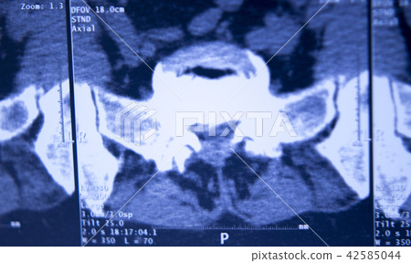 Medical hips spine pelvis MRI scan 42585044