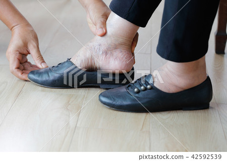 Elderly woman swollen feet putting on shoes Elderly woman swollen feet putting on shoes 42592539