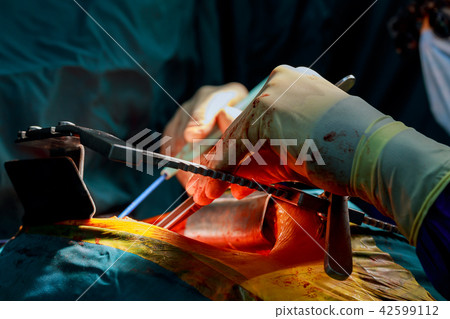 open heart surgery for coronary surgery 42599112