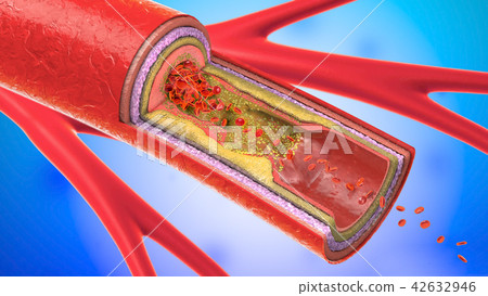 precipitated and narrowing blood vessels 42632946