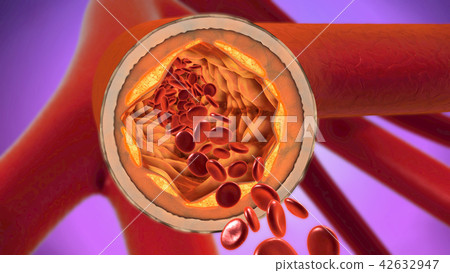 precipitated and narrowing blood vessels precipitated and narrowing blood vessels 42632947