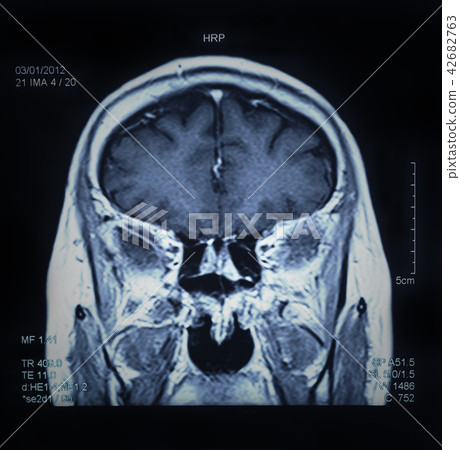 mri scan brain 42682763