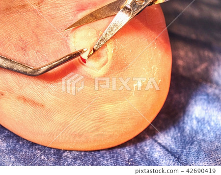 Deep wound on the skin. Scissors cut dead skin Deep wound on the skin. Scissors cut dead skin 42690419