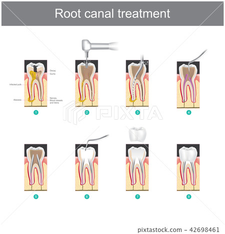 Root canal treatment. 42698461