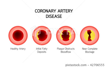 Coronary Artery Disease info graphic. 42706555