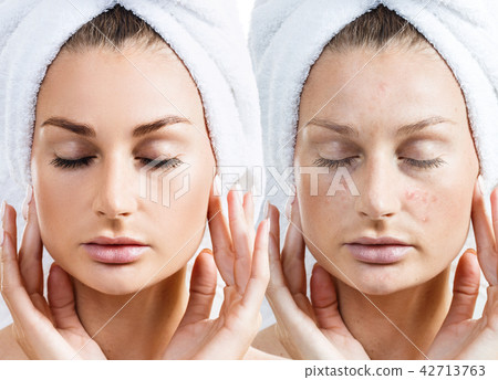 Girl with acne before and after treatment 42713763