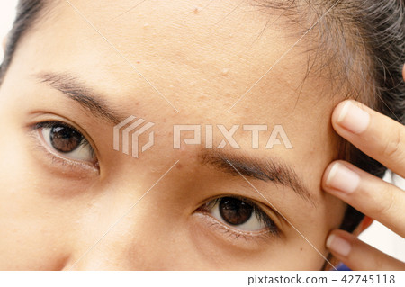 Forehead that is wrinkled and acne of woman. 42745118