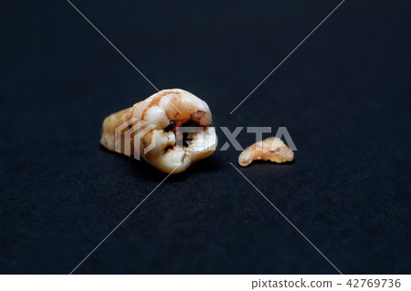 Broken Caries Molar on the iSolated. Broken Caries Molar on the iSolated. 42769736