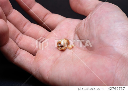 Broken Caries Molar on Male Hand iSolated Black. 42769737