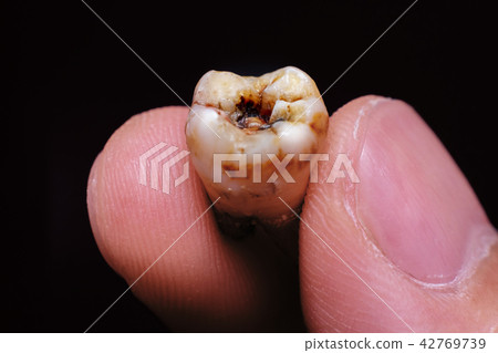 Broken Caries Molar on Male Hand iSolated Black. Broken Caries Molar on Male Hand iSolated Black. 42769739