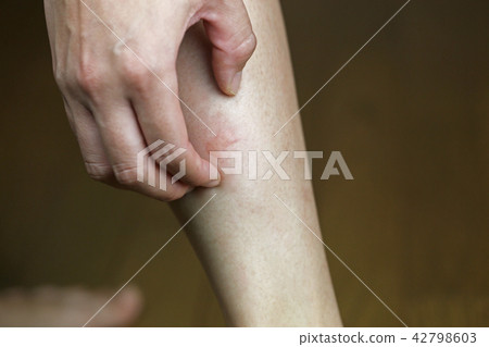 昆蟲叮咬 昆蟲叮咬 42798603