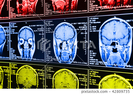 Magnetic resonance scan of the brain 42809735