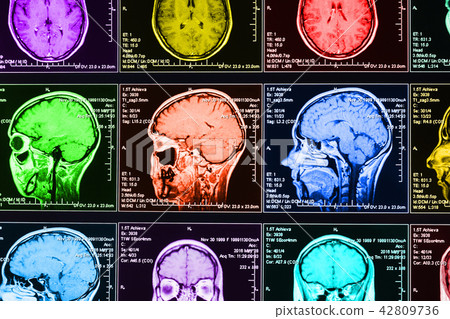 Magnetic resonance scan of the brain 42809736