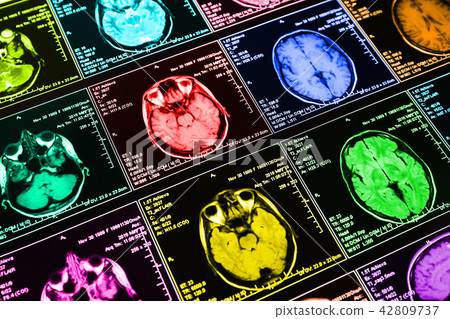 Magnetic resonance scan of the brain 42809737
