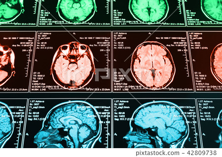 Magnetic resonance scan of the brain Magnetic resonance scan of the brain 42809738