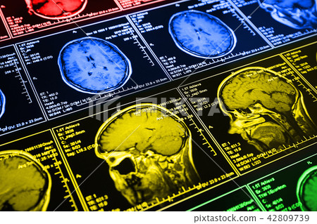 Magnetic resonance scan of the brain Magnetic resonance scan of the brain 42809739