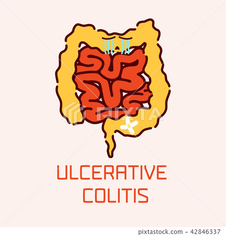 Ulcerative colitis poster 42846337
