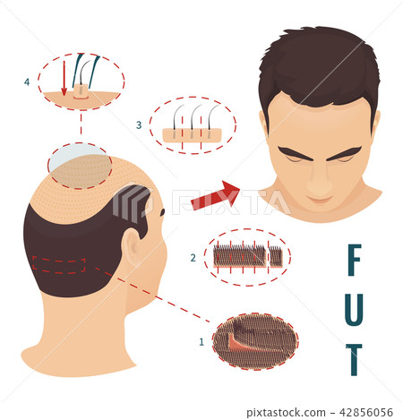 FUT hair loss treatment 42856056